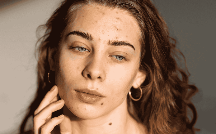 SOPK, comment traiter l’acné hormonale
