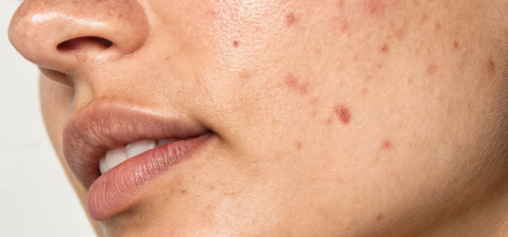 Harigheid en acne